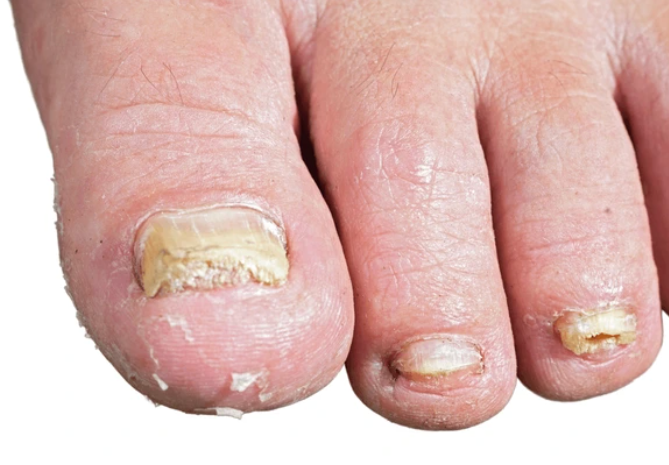 Before nails